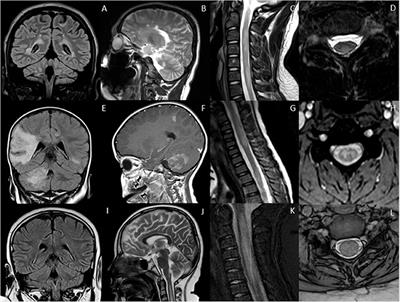 Relapsing Demyelinating Syndromes in Children: A Practical Review of Neuroradiological Mimics